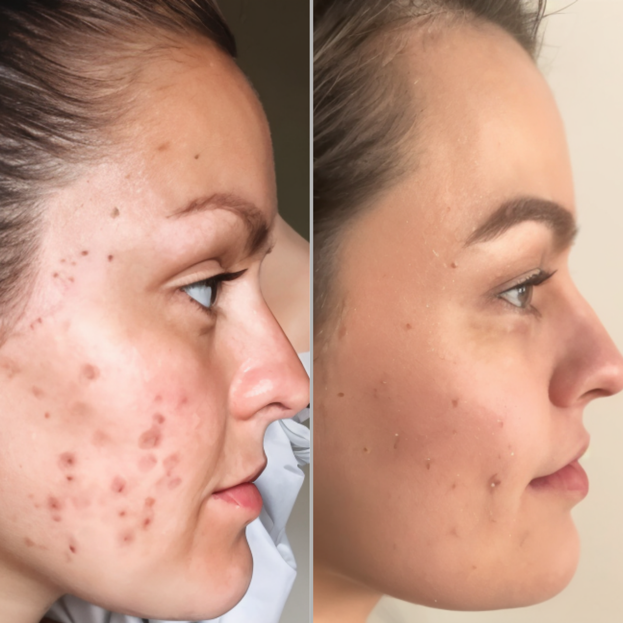 BeautiWave Pro™ – High Frequency Wand för akne & glow
