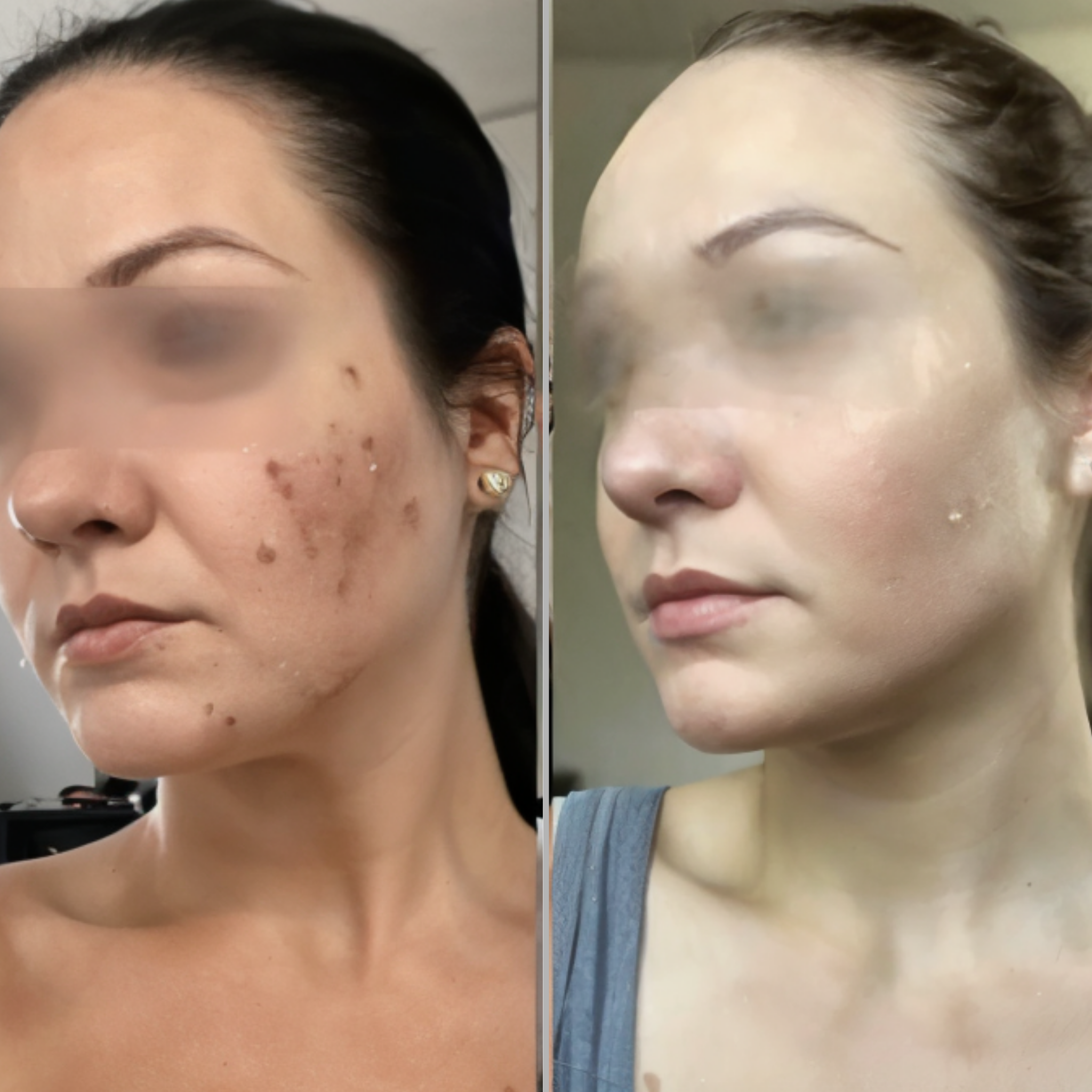 BeautiWave Pro™ – High Frequency Wand för akne & glow